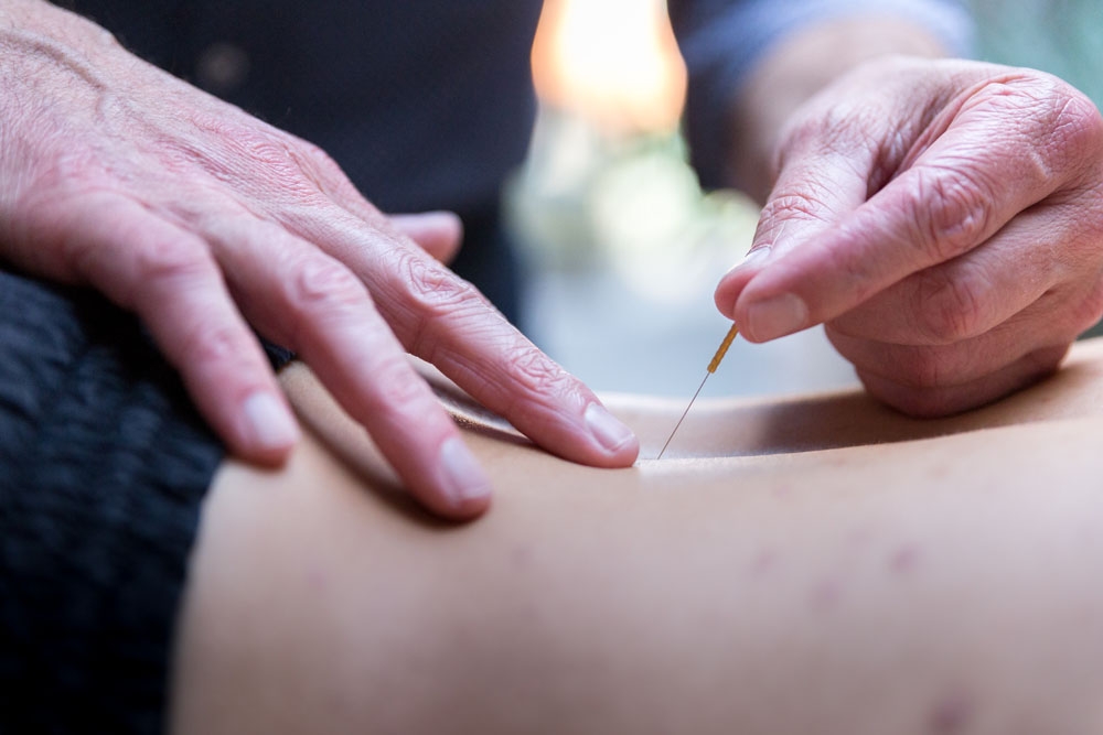Dry needling